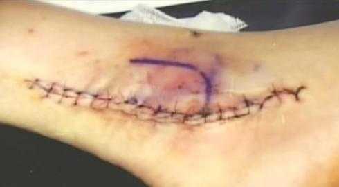 curt schilling ankle injury 2004